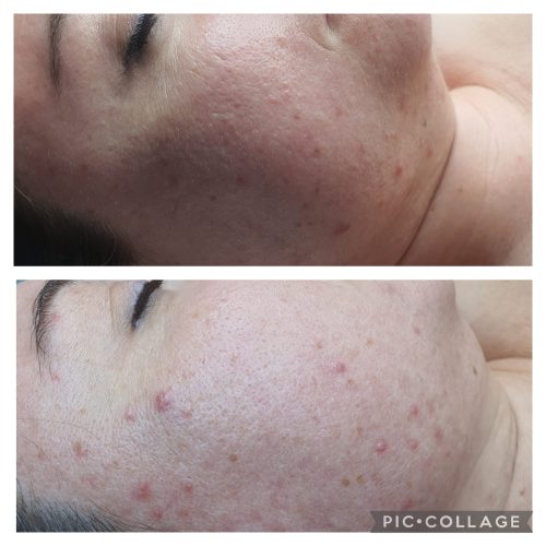 acne-angeles-noguera-estetic